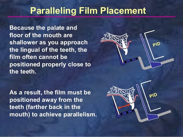 paralleling technique
