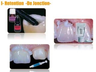 I- Retention -De Jonction-
 