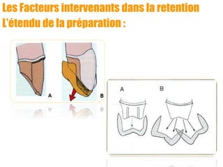 Les Facteurs intervenants dans la retention
L’étendu de la préparation :
 