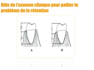 Rôle de l’examen clinique pour pallier le
problème de la rétention
 