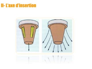 II- L’axe d’insertion
 