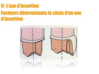 II- L’axe d’insertion
Facteurs déterminants le choix d’un axe
d’insertion
 