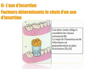 II- L’axe d’insertion
Facteurs déterminants le choix d’un axe
d’insertion
 