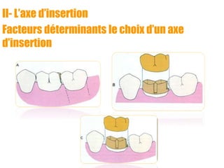 II- L’axe d’insertion
Facteurs déterminants le choix d’un axe
d’insertion
 