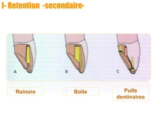 I- Retention -secondaire-
Rainure Boite Puits
dentinaires
 