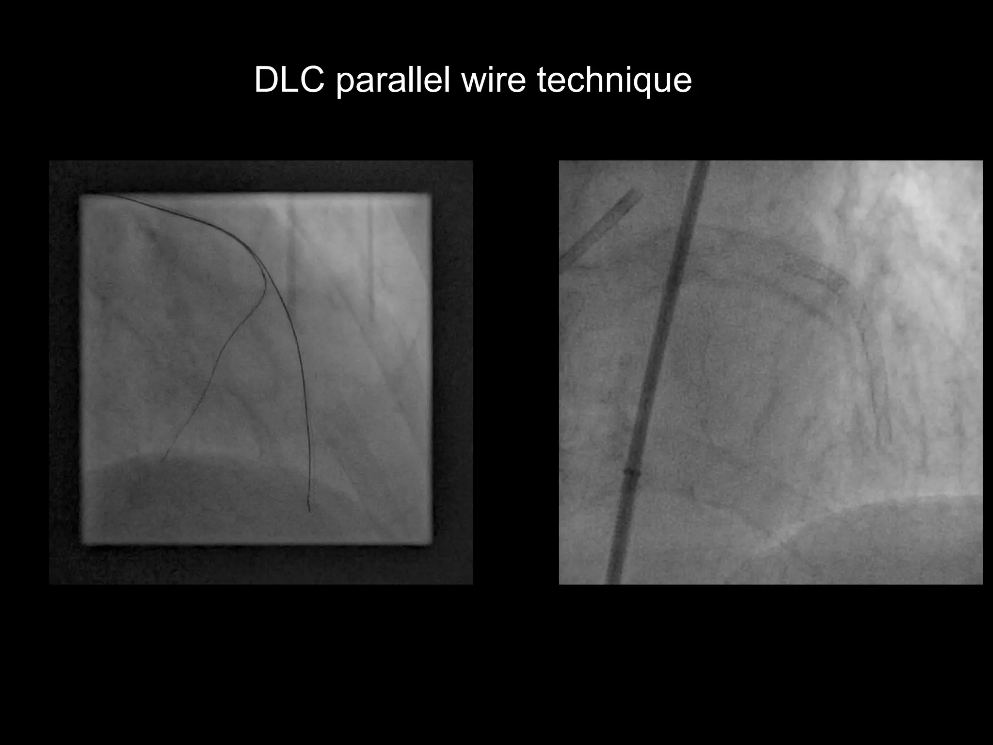 10
DLC parallel wire technique
 