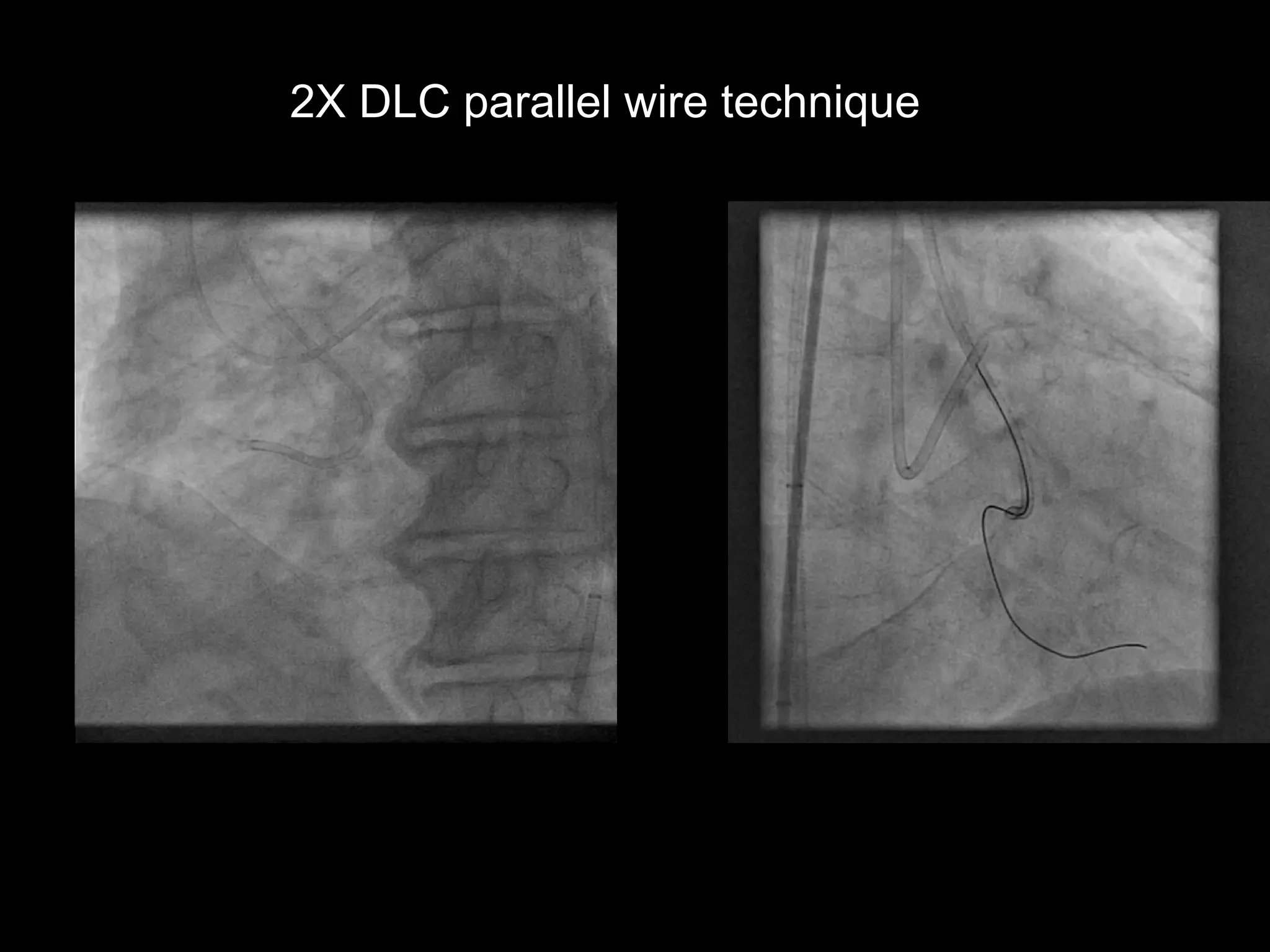 11
2X DLC parallel wire technique
 