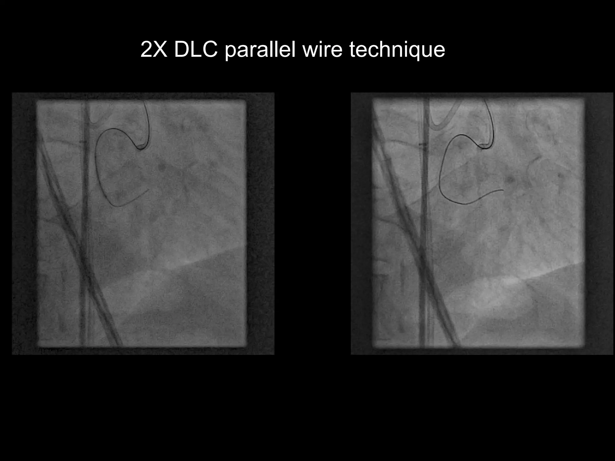 12
2X DLC parallel wire technique
 