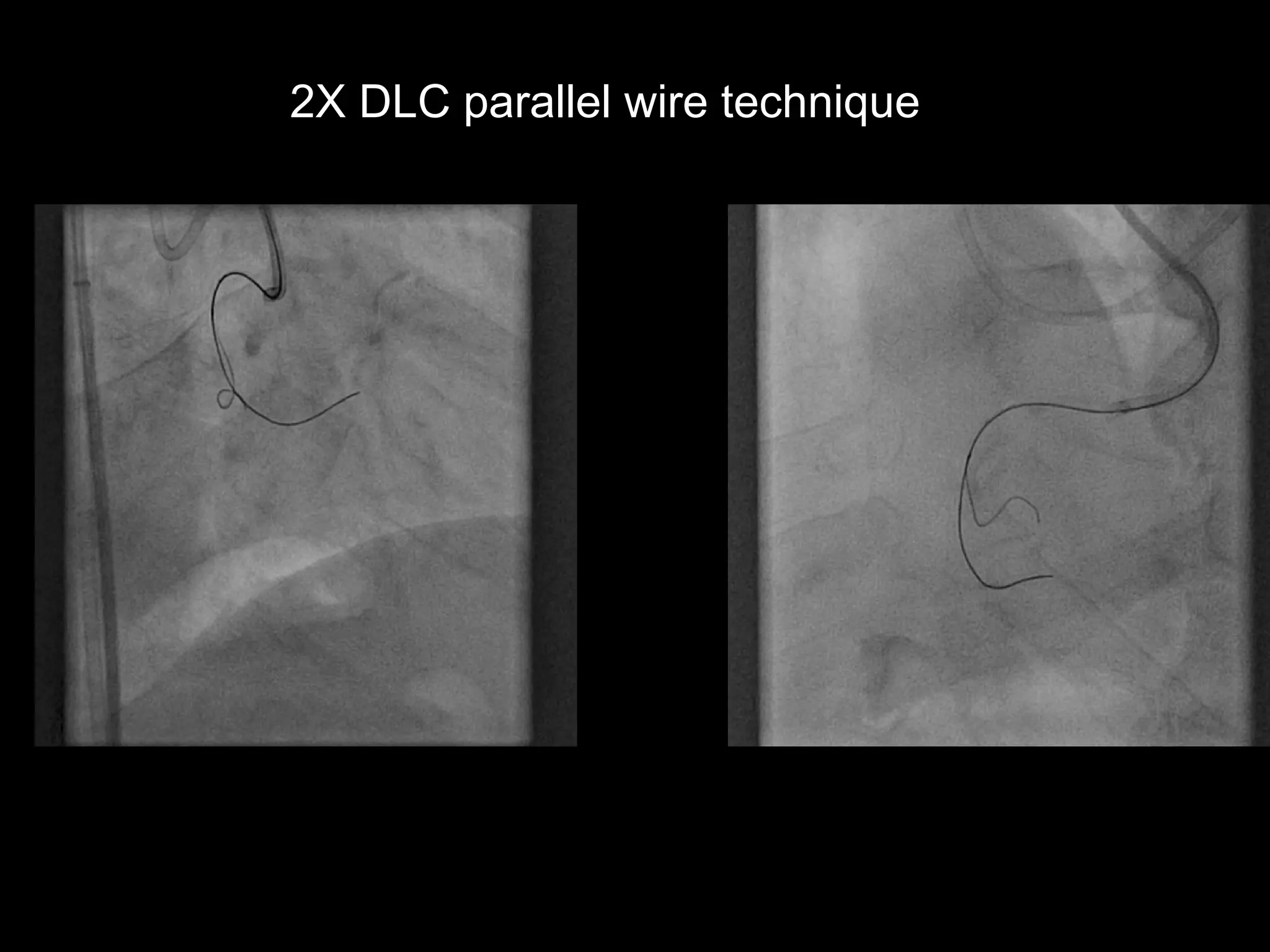 13
2X DLC parallel wire technique
 