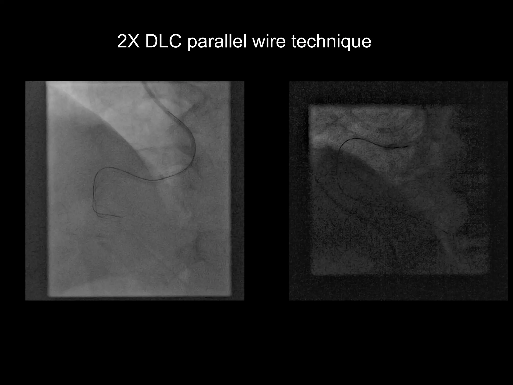 14
2X DLC parallel wire technique
 