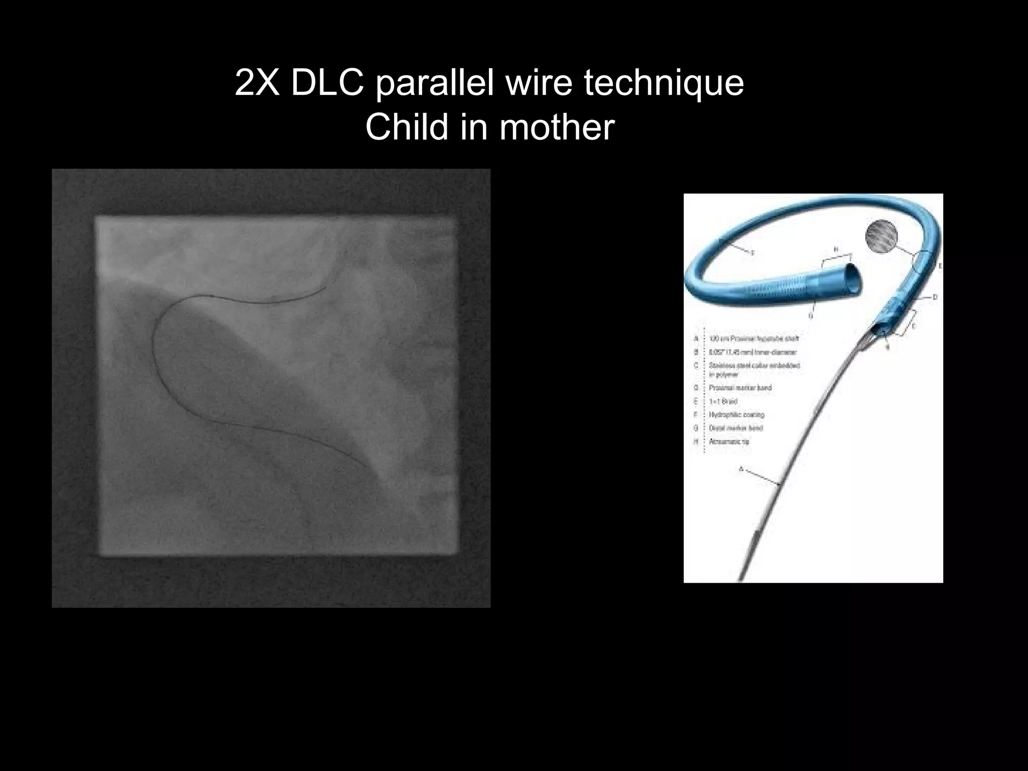 15
2X DLC parallel wire technique
Child in mother
 