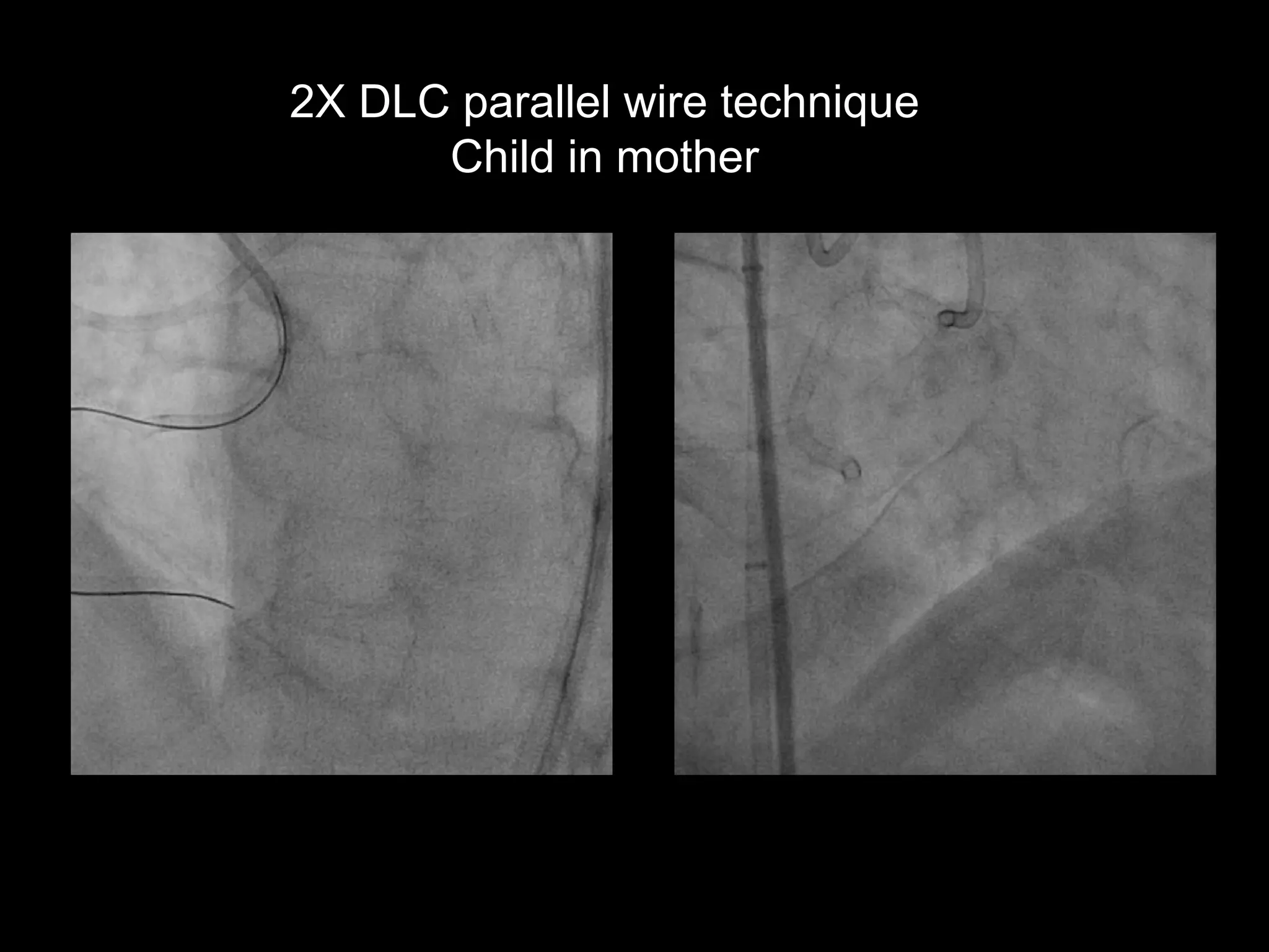 16
2X DLC parallel wire technique
Child in mother
 