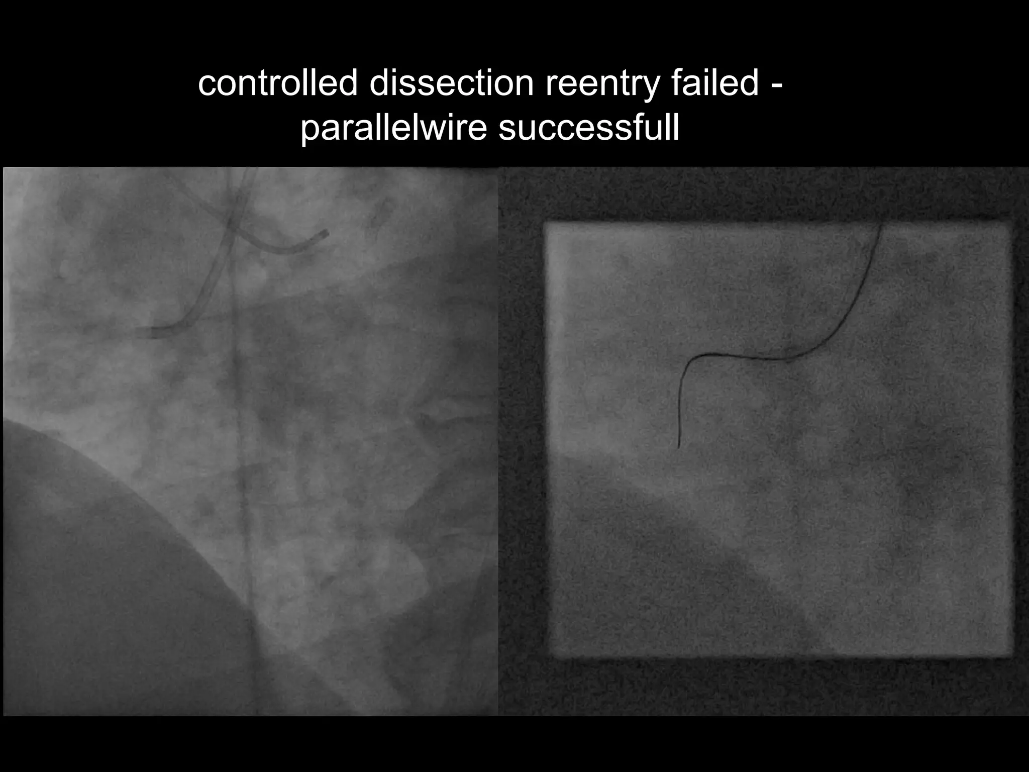 17
controlled dissection reentry failed -
parallelwire successfull
 