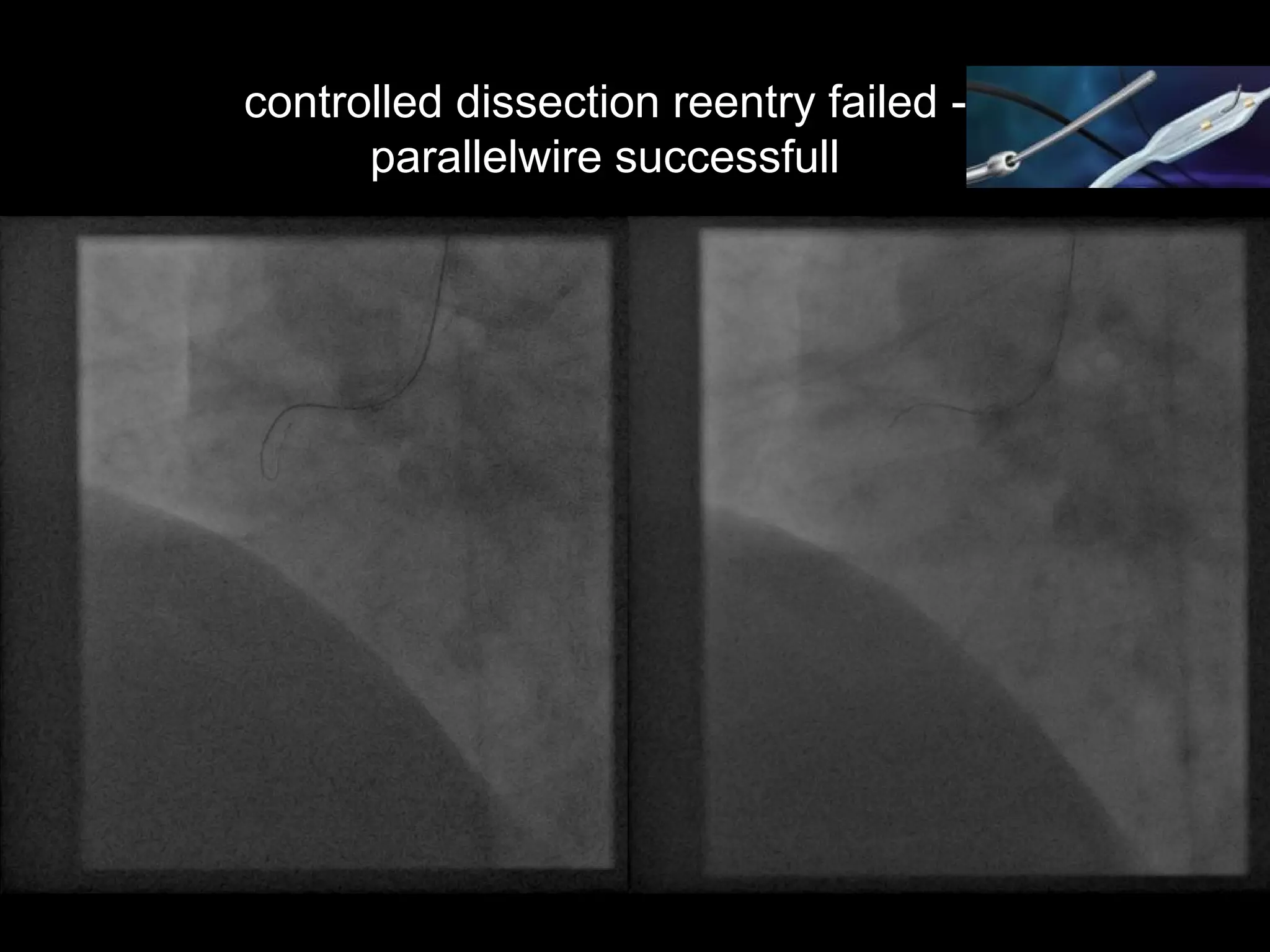 18
controlled dissection reentry failed -
parallelwire successfull
 