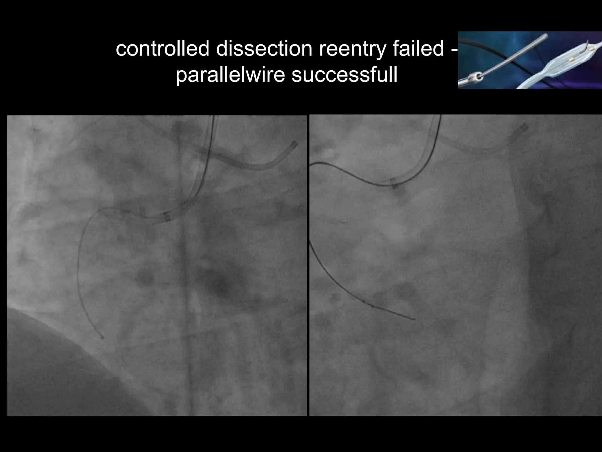 19
controlled dissection reentry failed -
parallelwire successfull
 