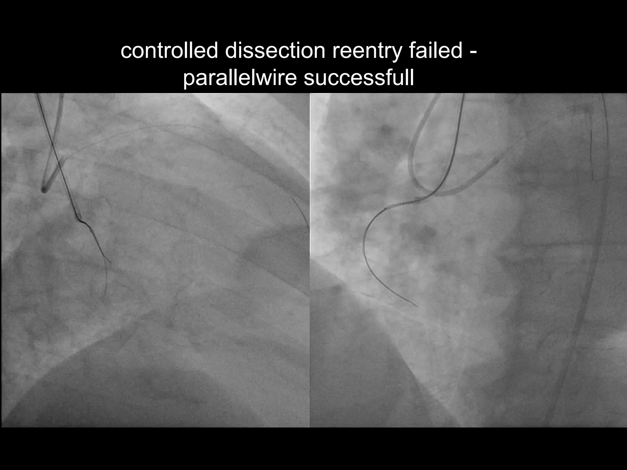 20
controlled dissection reentry failed -
parallelwire successfull
 
