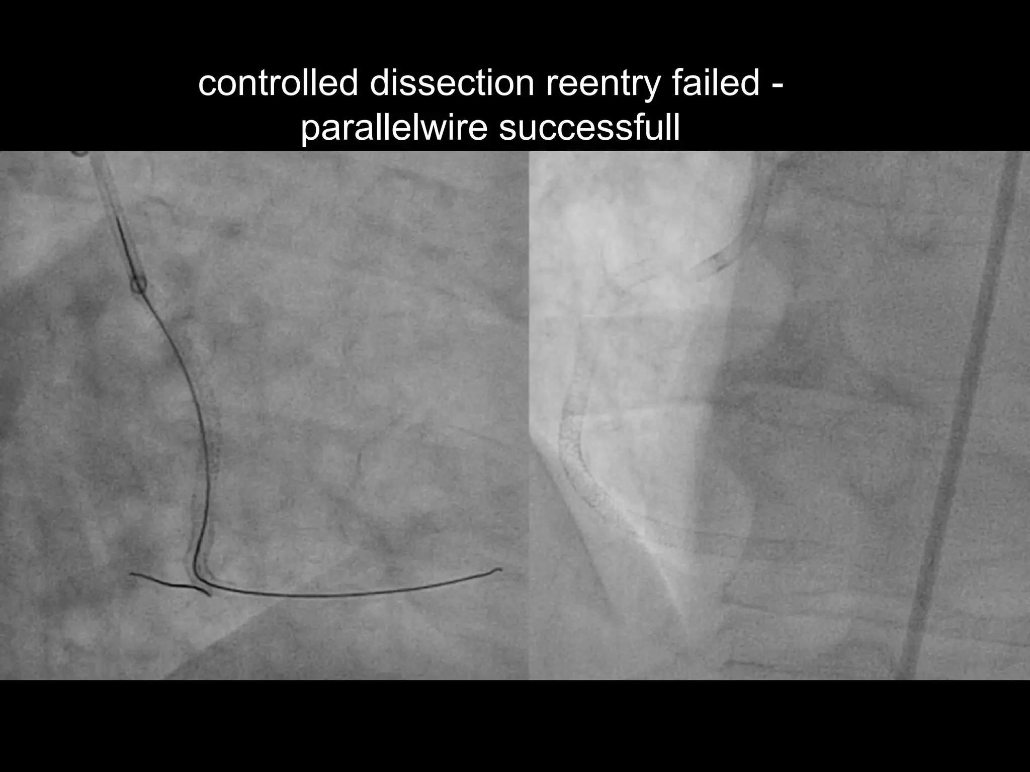 21
controlled dissection reentry failed -
parallelwire successfull
 