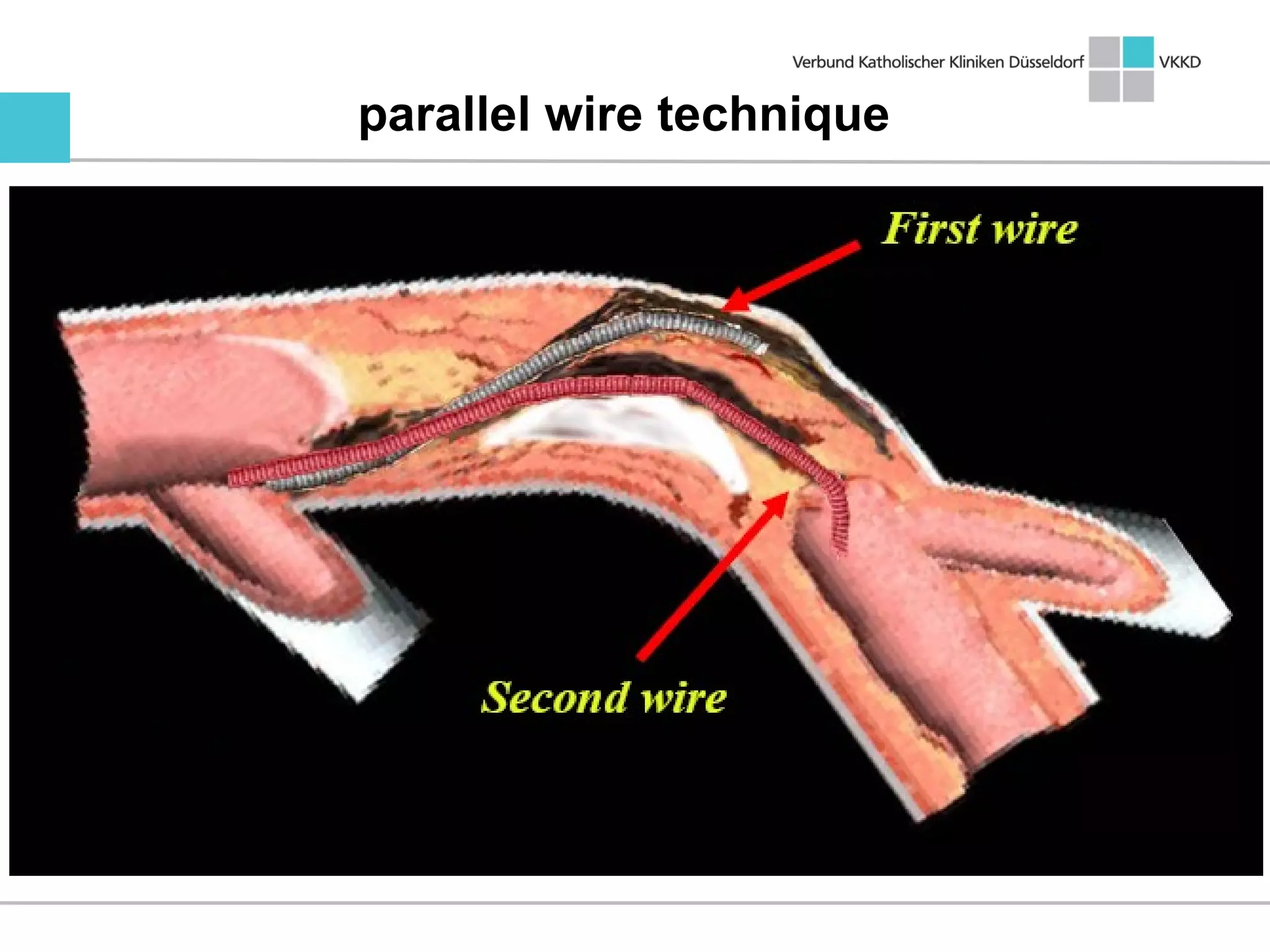 parallel wire technique
 