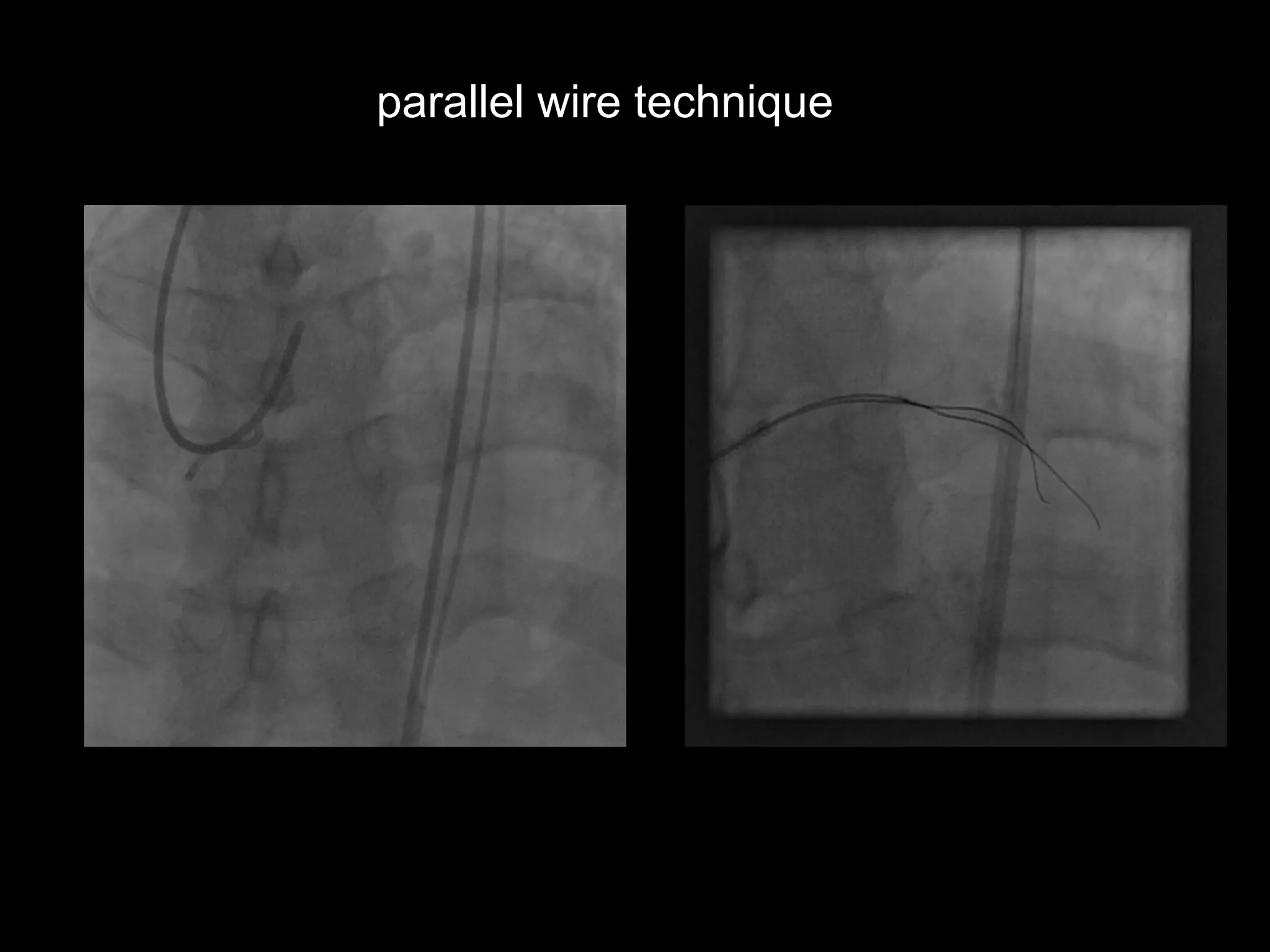 5
parallel wire technique
 