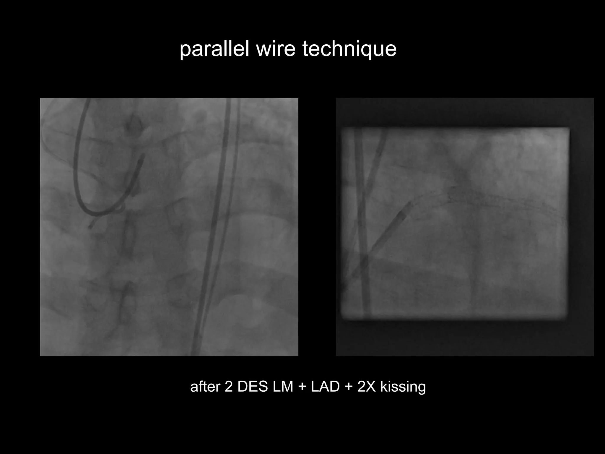 6
after 2 DES LM + LAD + 2X kissing
parallel wire technique
 