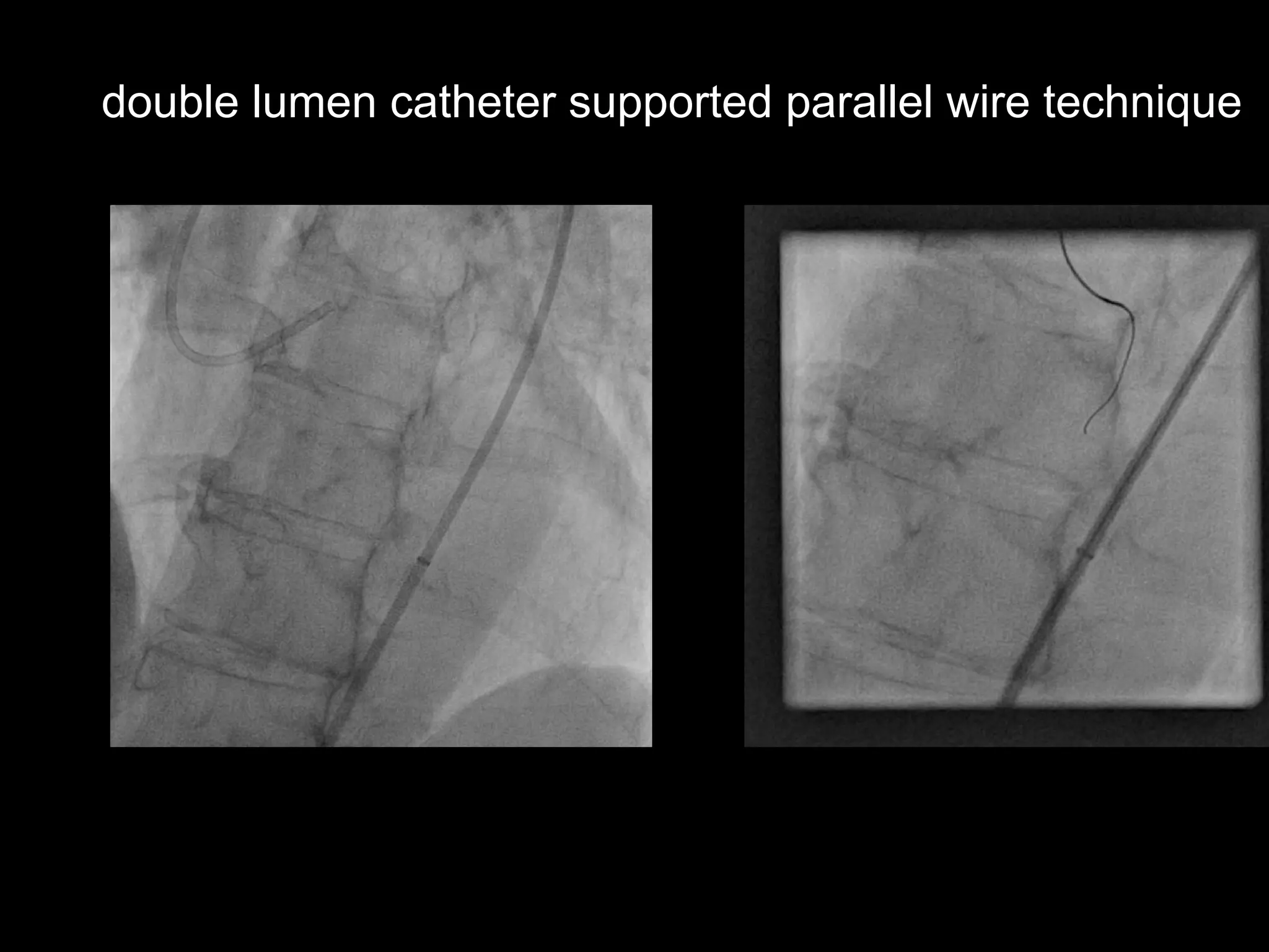 7
double lumen catheter supported parallel wire technique
 