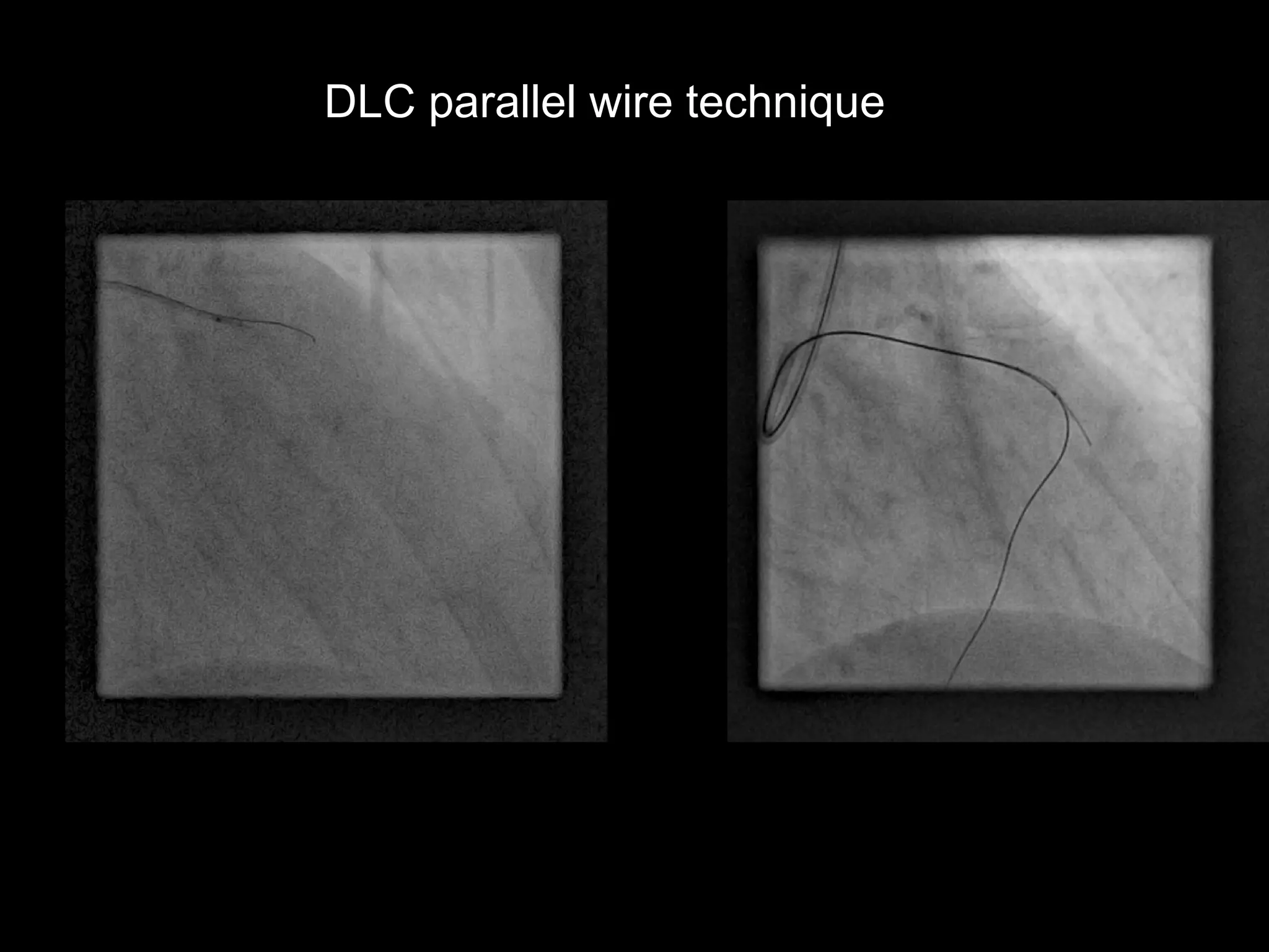 9
DLC parallel wire technique
 