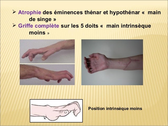 Paralysie des muscles intrinseques