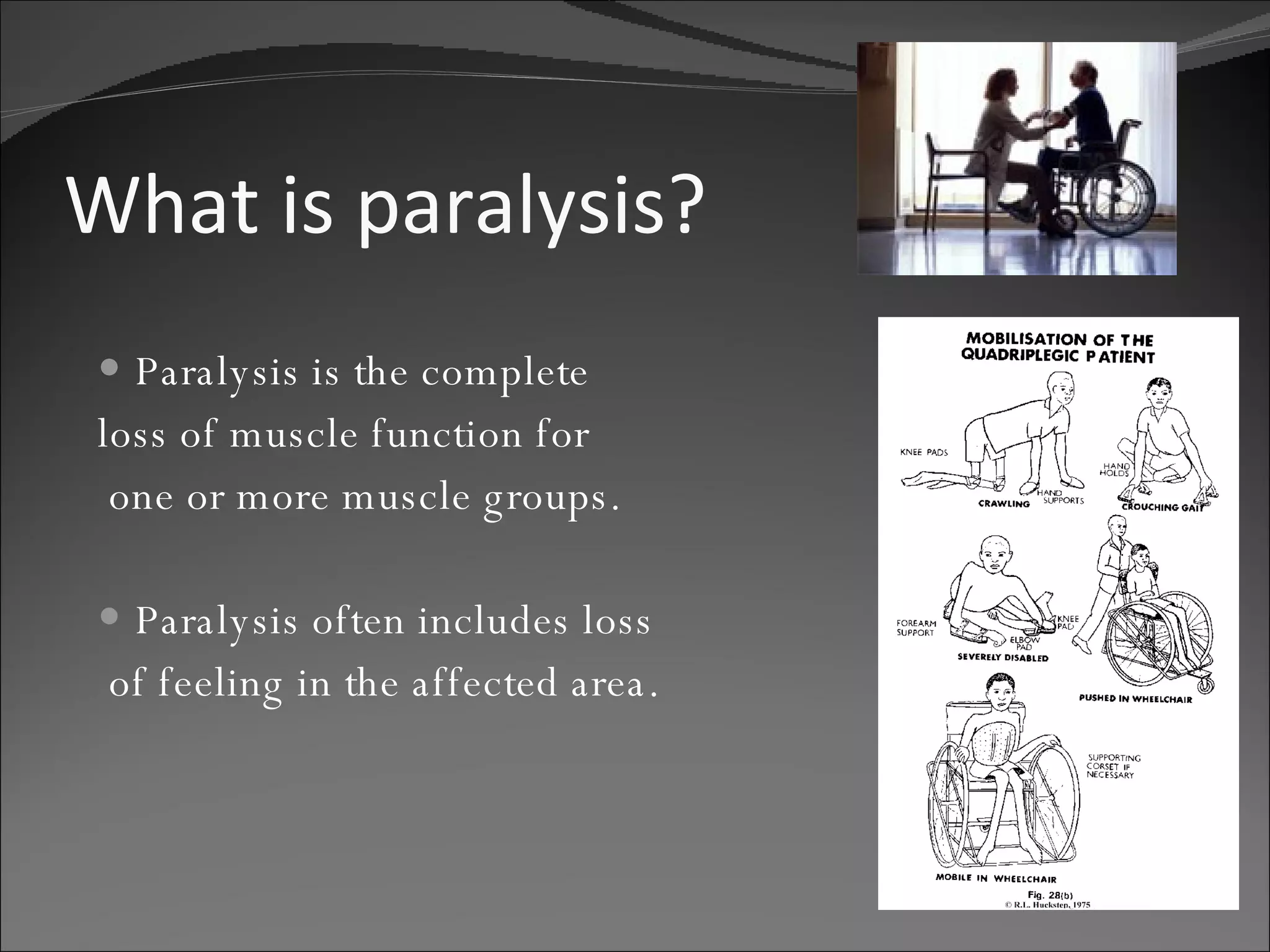 What is paralysis? Paralysis   is the complete  loss of muscle function for one or more muscle groups.  Paralysis often includes loss of feeling in the affected area. 