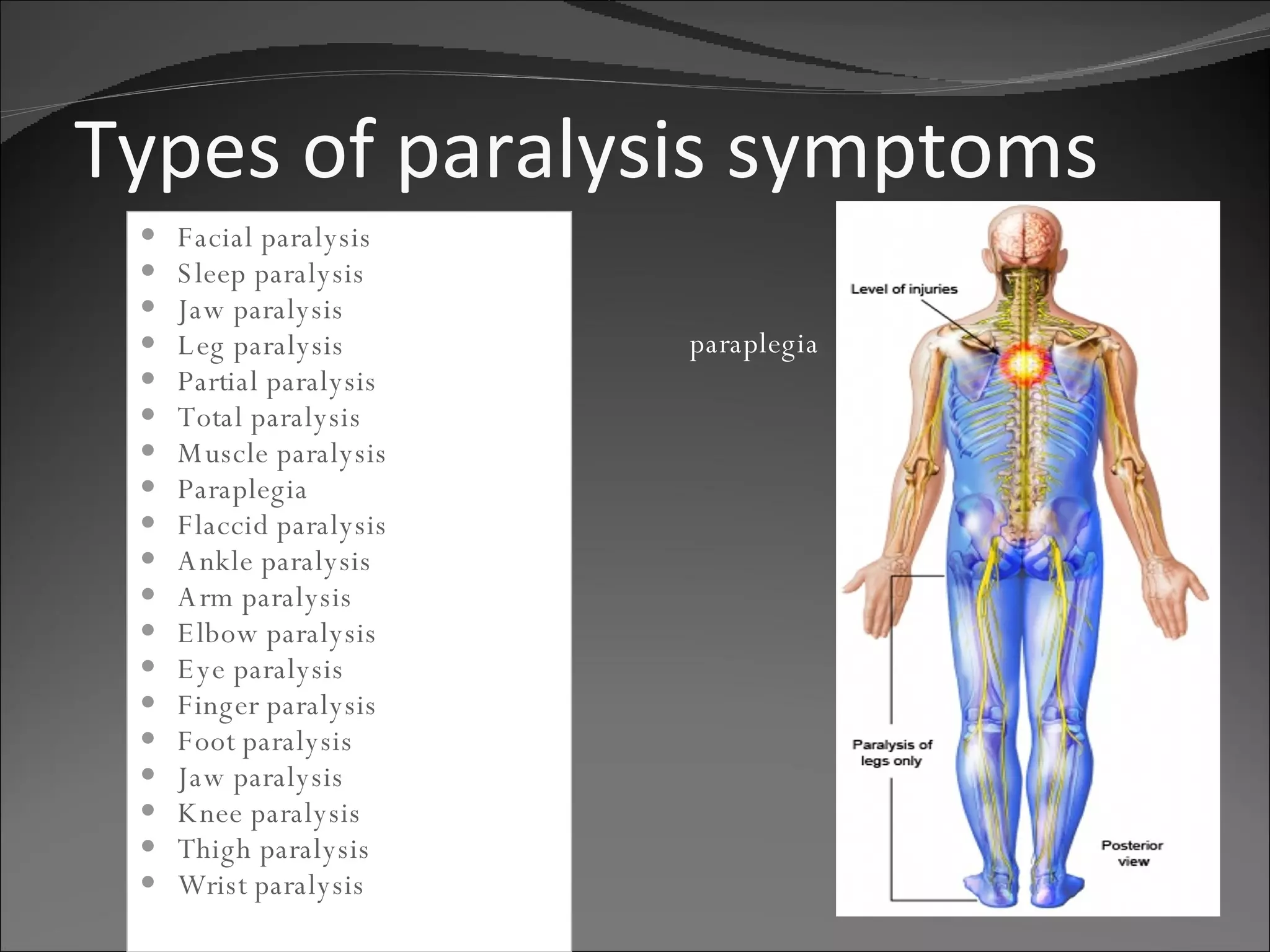 Types of paralysis symptoms Facial paralysis   Sleep paralysis   Jaw paralysis   Leg paralysis   Partial paralysis   Total paralysis   Muscle paralysis   Paraplegia   Flaccid paralysis   Ankle paralysis   Arm paralysis   Elbow paralysis   Eye paralysis   Finger paralysis   Foot paralysis   Jaw paralysis   Knee paralysis   Thigh paralysis   Wrist paralysis   paraplegia 