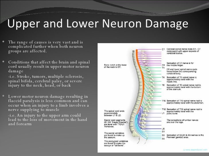 What Is Spinal Hemiplegia
