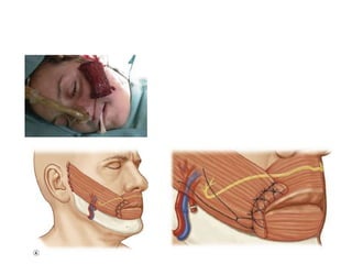 Paralysis of facial nerve | PPTX