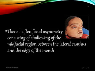 •There is often facial asymmetry
consisting of shallowing of the
midfacial region between the lateral canthus
and the edge of the mouth
9 February 2016PARALYTIC STRABISMUS
34
 