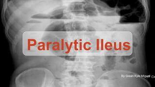 Paralytic Ileus
By Giean Kyle Miguel
 