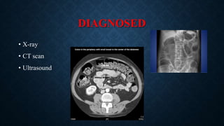 DIAGNOSED
• X-ray
• CT scan
• Ultrasound
 