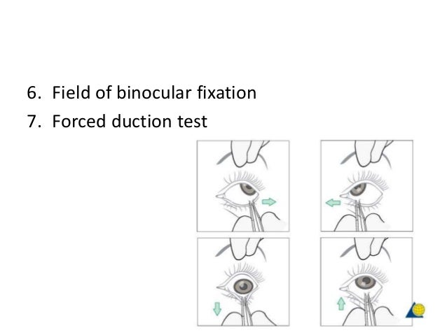 paralytic squint diplopia charting