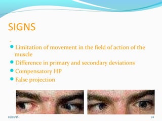 Paralytic strabismus, features and investigations of paretic strabismus ...