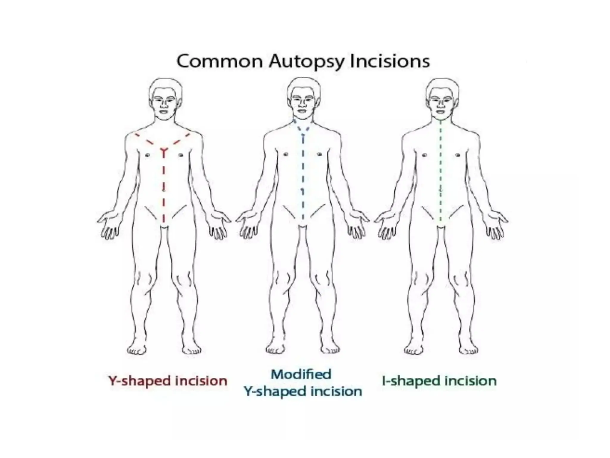 Autopsy , methods of the autopsy summary