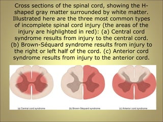 Cross sections of the spinal cord, showing the H-shaped 
gray matter surrounded by white matter. 
Illustrated here are the three most common types 
of incomplete spinal cord injury (the areas of the 
injury are highlighted in red): (a) Central cord 
syndrome results from injury to the central cord. 
(b) Brown-Séquard syndrome results from injury to 
the right or left half of the cord. (c) Anterior cord 
syndrome results from injury to the anterior cord. 
 