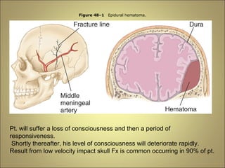 Figure 48–1 Epidural hematoma. 
Pt. will suffer a loss of consciousness and then a period of 
responsiveness. 
Shortly thereafter, his level of consciousness will deteriorate rapidly. 
Result from low velocity impact skull Fx is common occurring in 90% of pt. 
 