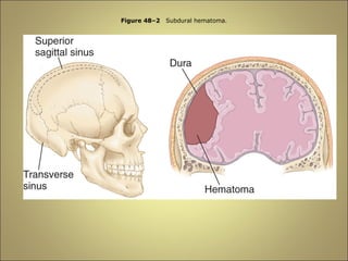 Figure 48–2 Subdural hematoma. 
 