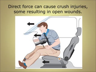 Direct force can cause crush injuries, 
some resulting in open wounds. 
 