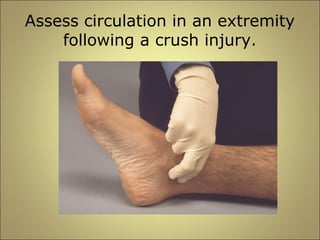 Assess circulation in an extremity 
following a crush injury. 
 