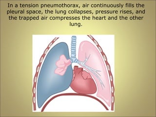In a tension pneumothorax, air continuously fills the 
pleural space, the lung collapses, pressure rises, and 
the trapped air compresses the heart and the other 
lung. 
 