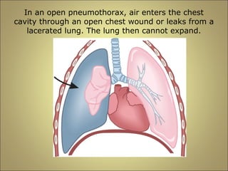 In an open pneumothorax, air enters the chest 
cavity through an open chest wound or leaks from a 
lacerated lung. The lung then cannot expand. 
 