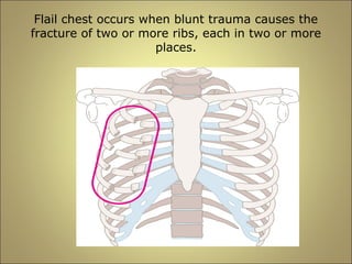 Flail chest occurs when blunt trauma causes the 
fracture of two or more ribs, each in two or more 
places. 
 