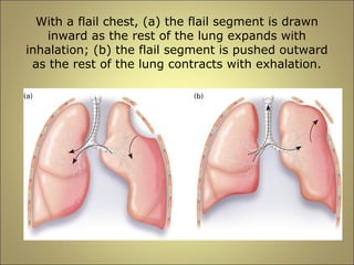 With a flail chest, (a) the flail segment is drawn 
inward as the rest of the lung expands with 
inhalation; (b) the flail segment is pushed outward 
as the rest of the lung contracts with exhalation. 
 