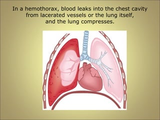 In a hemothorax, blood leaks into the chest cavity 
from lacerated vessels or the lung itself, 
and the lung compresses. 
 