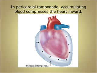 In pericardial tamponade, accumulating 
blood compresses the heart inward. 
 