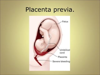 Placenta previa. 
 