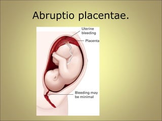 Abruptio placentae. 
 